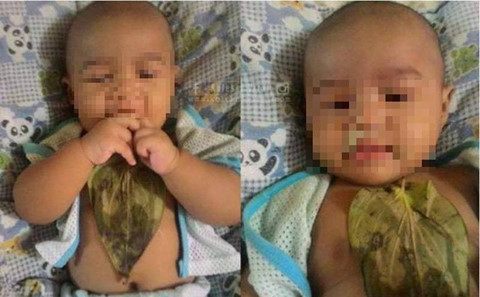 Đắp lá chữa sổ mũi, bé 6 tháng tuổi bị bỏng nặng