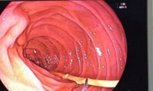 Đoạn nhang nằm trong thành ruột người đàn ông. Ảnh: BVCC.