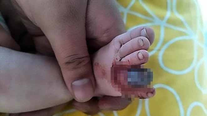 Ngón chân chuyển sang màu đen do bị sợi tóc quấn chặt. Ảnh: Daily Mail.