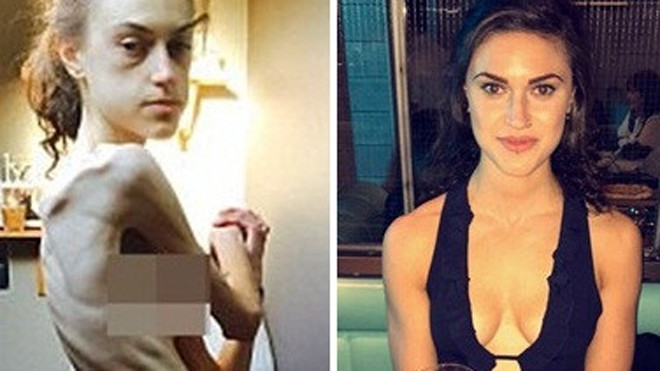 Emelle đã kịp nhận ra tình trạng gầy trơ xương và có biện pháp phục hồi. Ảnh: Daily Mail.