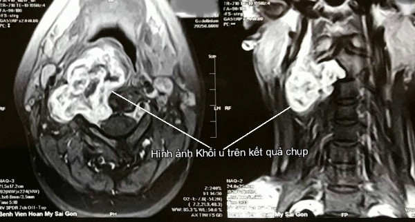 Hình ảnh khối u trên MRI.