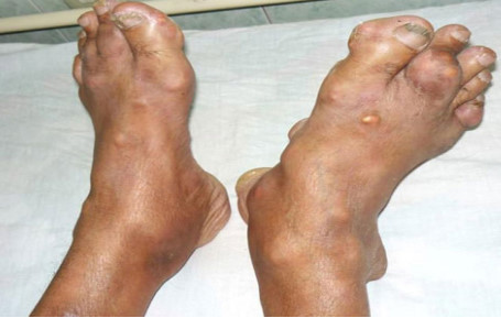Chân bệnh nhân mắc bệnh gout. Ảnh: BSCC.