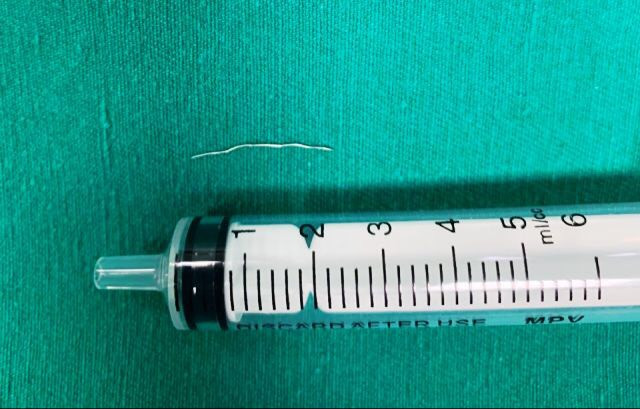 Gắp sợi kim loại trong cổ bệnh nhi 8 tháng tuổi