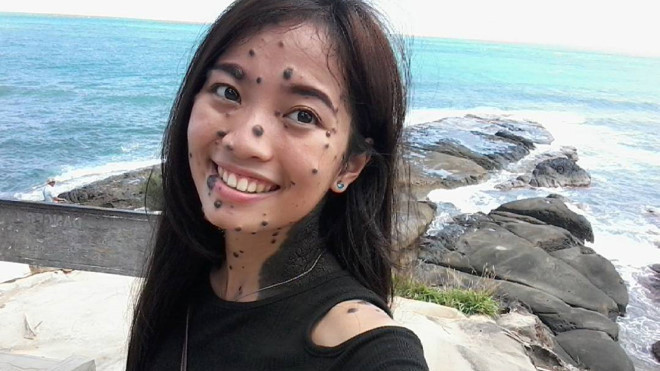 Từ khi sinh ra, Evita Delmundo đã có rất nhiều nốt ruồi trên khắp cơ thể.