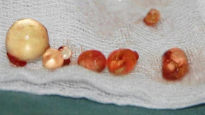 Những khối silicone được lấy ra từ bộ phận sinh dục của nam bệnh nhân. Ảnh: Đ.H.