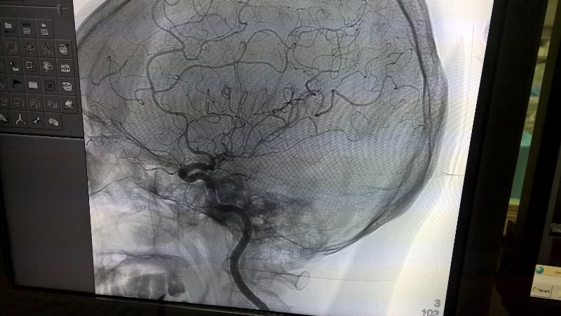 Chụp tổng quát mạch máu não (DSA) bằng kỹ thuật tiên tiến nhất hiện nay của thế giới.