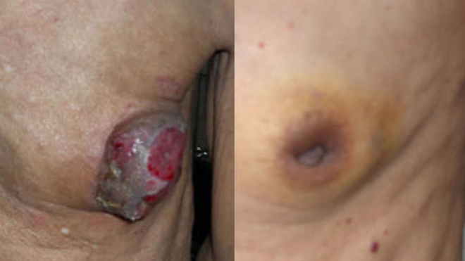 Nam giới mắc ung thư vú khó phát hiện hơn phụ nữ.