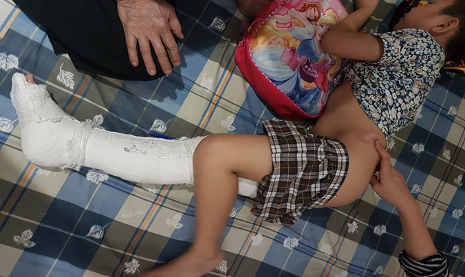 Xương đùi phải của Kiên bị gãy, phải bó bột.