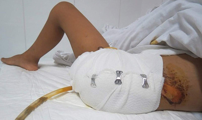 Bệnh nhân tự cắt chân.