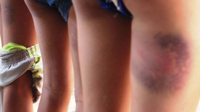 Vết bầm tím vẫn còn hằn trên da thịt học sinh lớp 7/1 sau 3 ngày bị đánh.