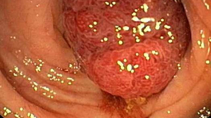 Hình ảnh ung thư đại tràng