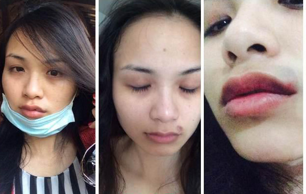 Gương mặt Diễm Hương có nhiều vết bầm mà theo cô là bị chồng cũ hành hung