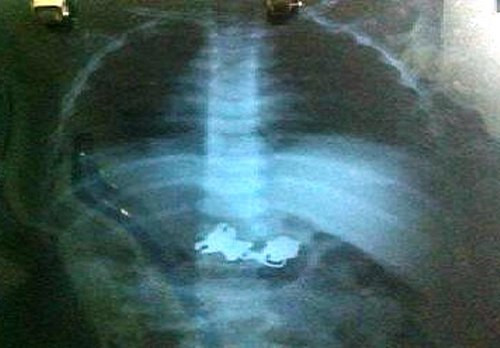 Mổ lấy chìa khóa trong dạ dày bé 25 tháng tuổi