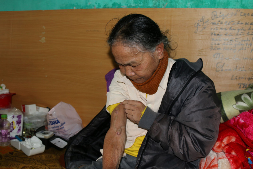 Sau những lần lọc máu, cơ thể bà Minh ngày càng rệu rã, chân tay sưng vù, nổi hạch, thường xuyên bị cơn đau buốt hành hạ