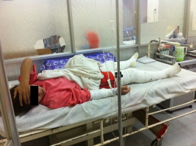 Nạn nhân đang điều trị tại khoa bỏng tạo hình, Bệnh viện Chợ Rẫy TPHCM. Ảnh: Quốc Ngọc