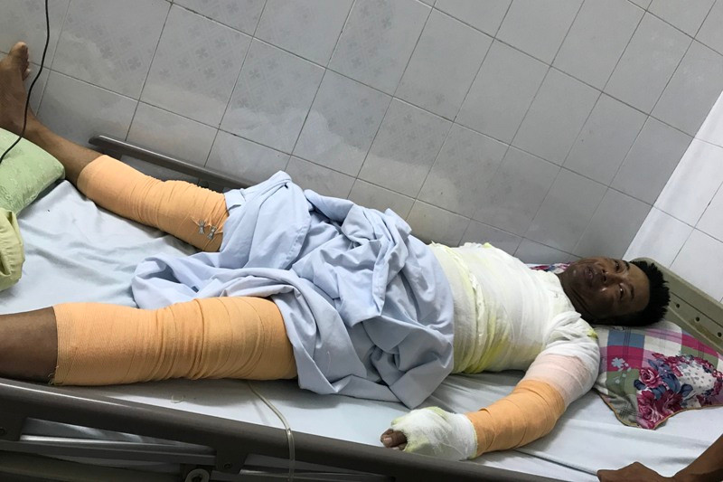 Anh Xuân bị cháy xém mặt và bỏng toàn thân do bình gas phát nổ. Ảnh: Minh Hoàng