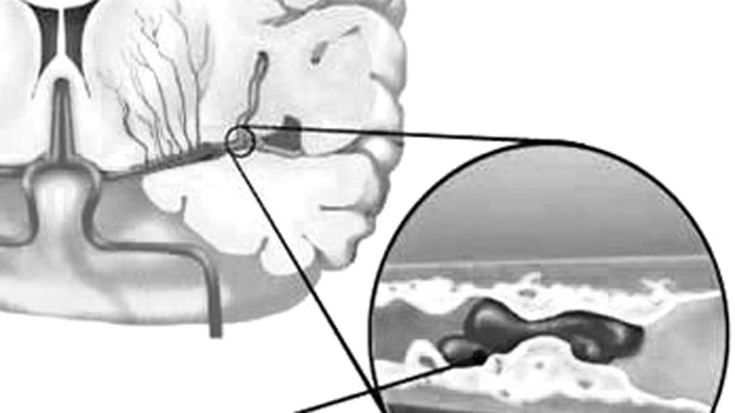 Huyết ứ gây thiếu máu não.