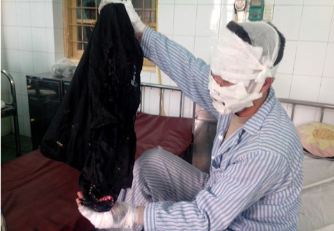 nh Đ. bị bỏng kín mặt và 2 tay. Chiếc áo khoác anh mặc cũng bị cháy.