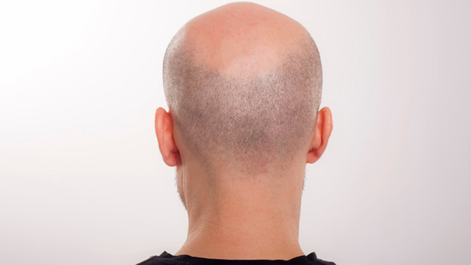 Không cấp phí mua tóc giả cho đàn ông hói