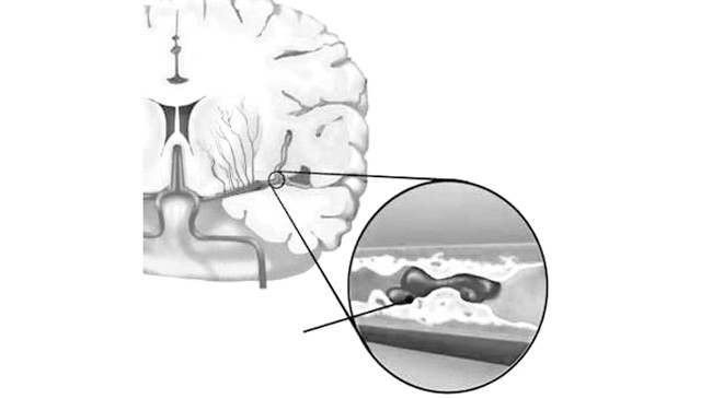 Huyết ứ gây thiếu máu não.