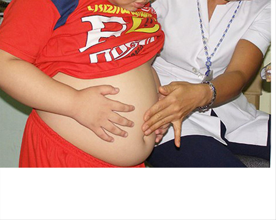 Tỷ lệ trẻ em ở thành thị bị béo phì đang tăng nhanh 