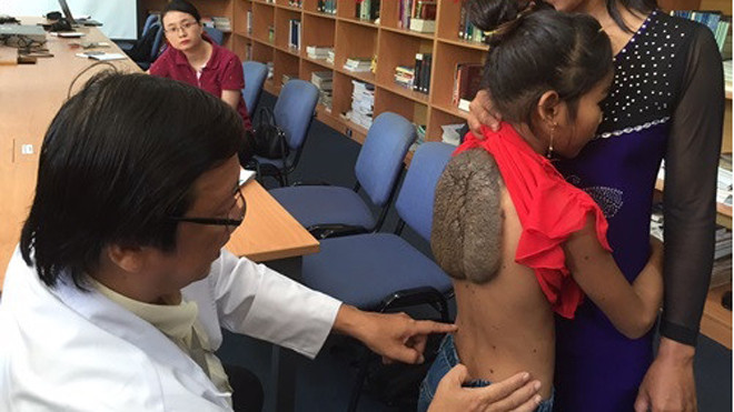 “Cô bé mai rùa” trước khi được phẫu thuật. Ảnh: Quốc Ngọc