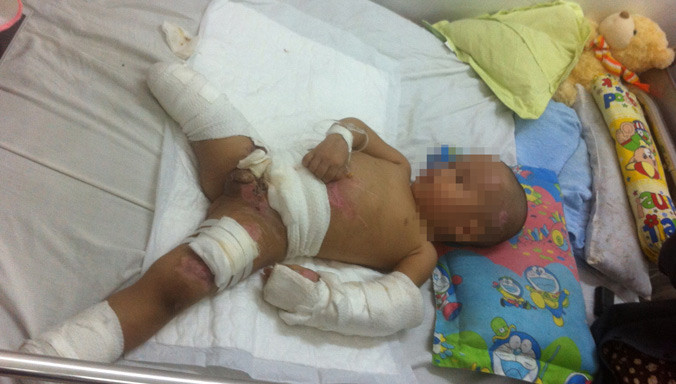 Bé Huy hiện đang điều trị tại khoa bỏng - chỉnh trực, Bệnh viện Nhi đồng 2 TPHCM. Ảnh: Quốc Ngọc