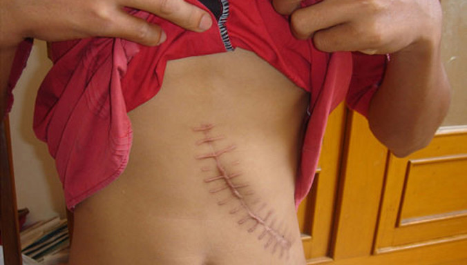 Do túng quẫn về kinh tế, nhiều người đã phải tìm đến các đường dây bán thận. Ảnh minh họa