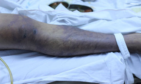 Hoại tử trên da do ăn phải lợn nhiễm liên cầu khuẩn