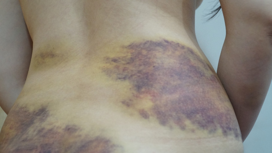 Vết thương trên cơ thể chị Sang