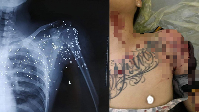 Nạn nhân bị mảnh đạn của súng hoa cải găm khắp phần ngực. Ảnh: Hoàng Long 