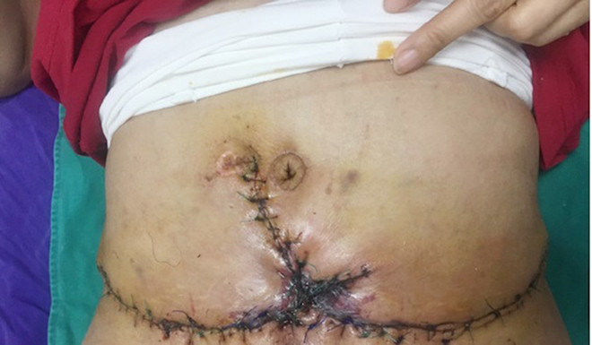 Hoại tử nặng vì hút mỡ bụng giảm béo