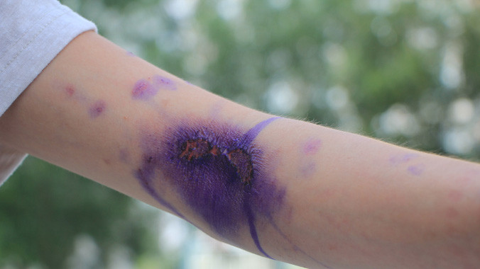 Cánh tay sinh viên Thanh Phúc chi chít vết lở loét.