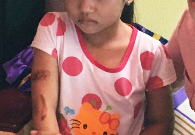 cháu T. và vết bỏng chưa lành trên tay