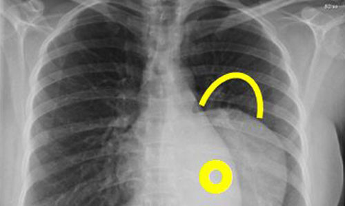 Hình ảnh một khối u trung thất.