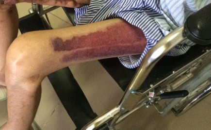 Tổng thương trên cơ thể bệnh nhân.