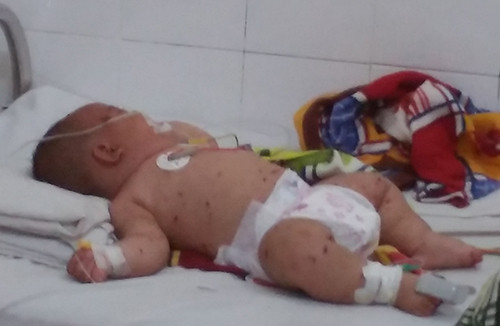 Bệnh nhi L.A.P đang được theo dõi điều trị tại bệnh viện.