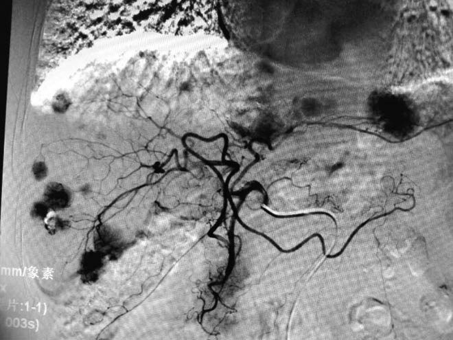 Thuốc nhuộm chỉ ra các khối đa ổ trong gan của bệnh nhân, trên phim chẩn đoán hình ảnh cho thấy từng khối thực thể tập trung tại các đầu mao mạch.