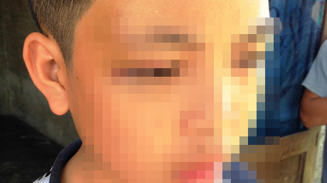 Học sinh T.V.T bị giáo viên Võ Thế Lân vụt thẳng gậy tre vào mặt gây thương tích, bầm tím ở vùng mắt phải