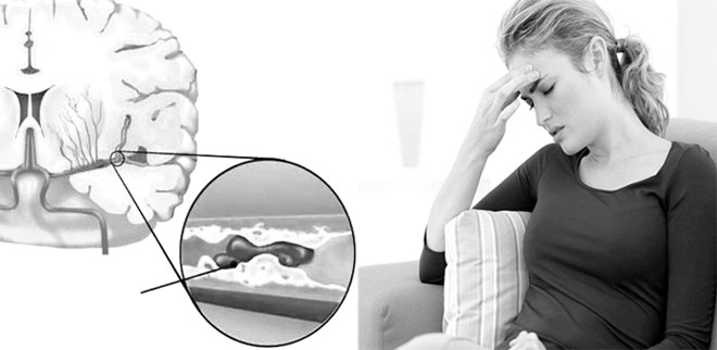 Đối phó với chứng thiếu máu não