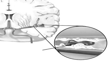 Thiểu năng tuần hoàn não