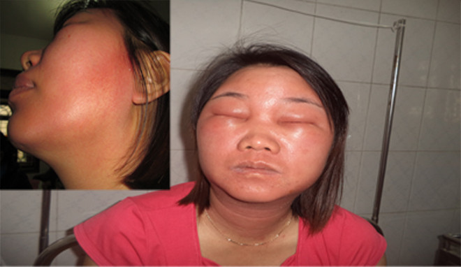 Bệnh nhân bị dị ứng mỹ phẩm đều phải điều trị tại Viện Da liễu T.Ư