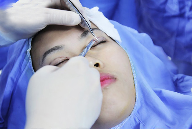 Các chuyên gia mắt cảnh báo, nhấn mí chìm (không khâu) cũng có thể tiềm ẩn rủi ro nguy hiểm cho thị lực thậm chí là tính mạng của bệnh nhân nếu được thực hiện ở cơ sở không đảm bảo (ảnh minh họa) Ảnh: PV