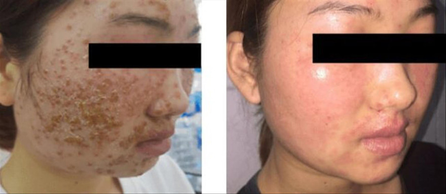 Bệnh nhân trước và sau 5 ngày điều trị 