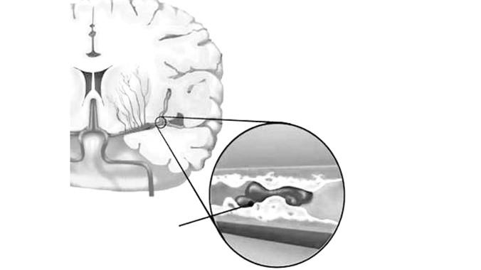 Huyết ứ gây thiếu máu não