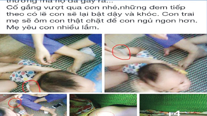 Người mẹ trẻ chia sẻ hình ảnh và tâm trạng trên Facebook (Thương tổn trên thân thể bé - các điểm khoanh tròn)	