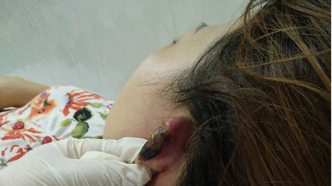 Nguy cơ bỏng da đầu, hoại tử vành tai của do làm đẹp.