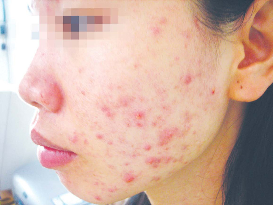 Một nạn nhân của dị ứng mỹ phẩm