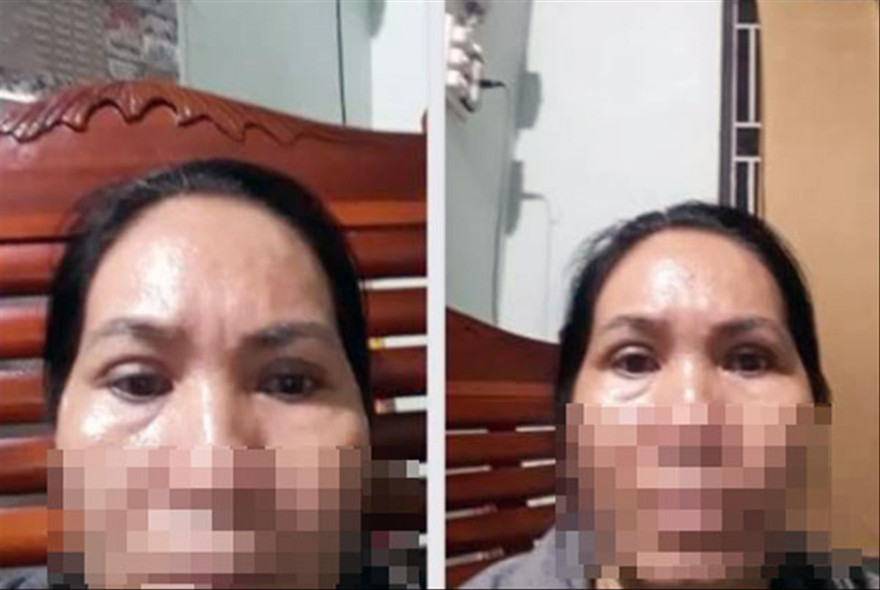 Sau hai lần phẫu thuật, đôi mắt của ba L. không như kỳ vọng