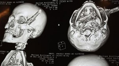 Vị trí con dao xuyên qua đầu của Juacelo Nunes de Oliveira. Ảnh: 9news.com.au